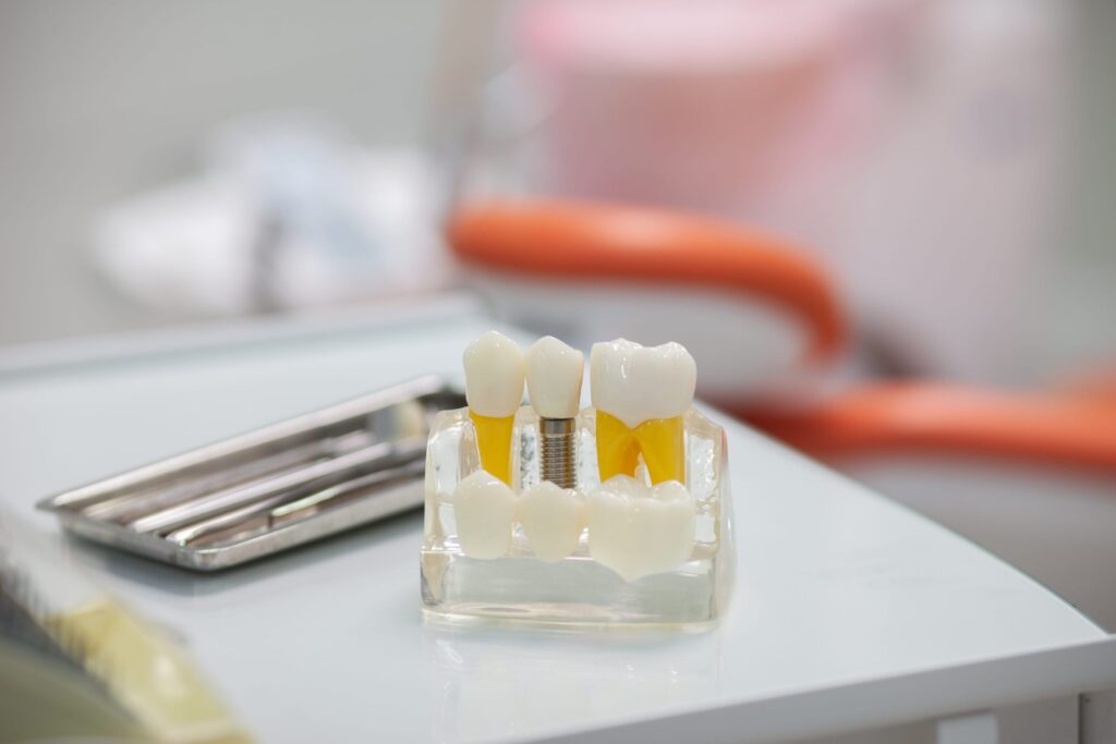 All-on-4 Dental Implants