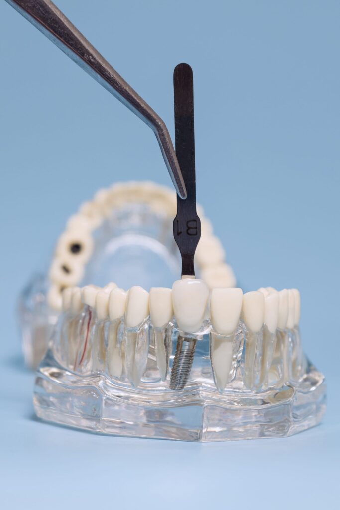 dental implants near me