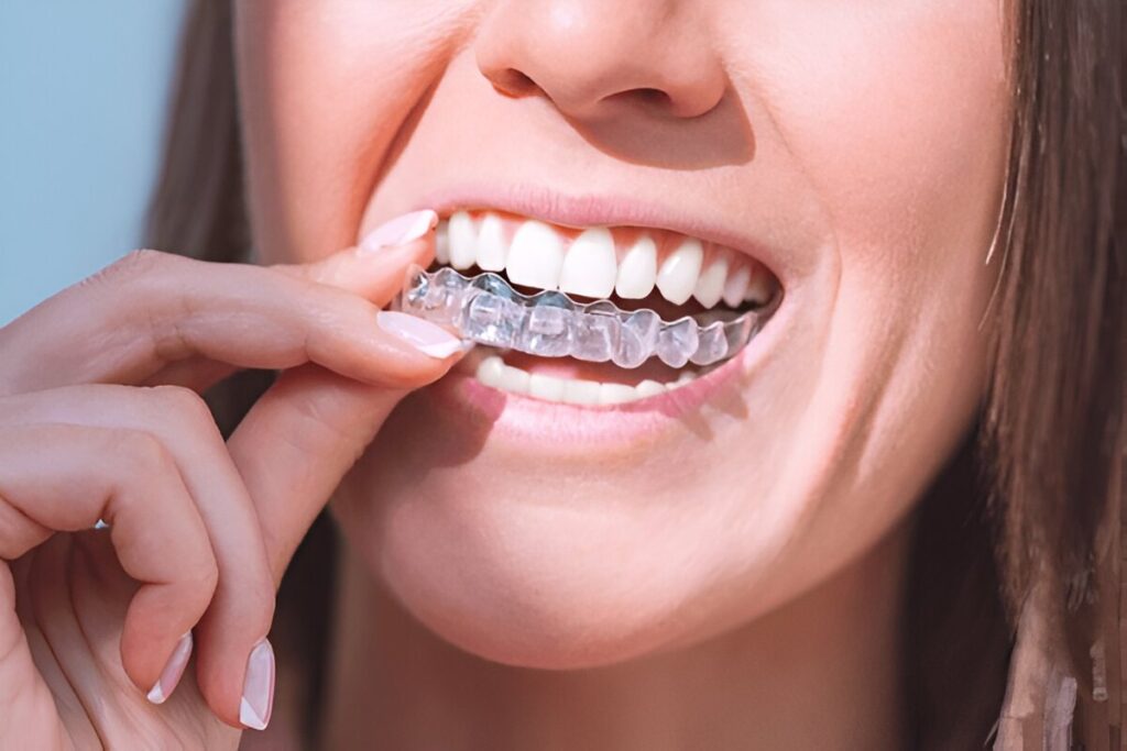 Placing a clear Invisalign aligner