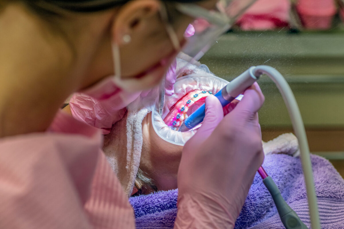 dental cleaning