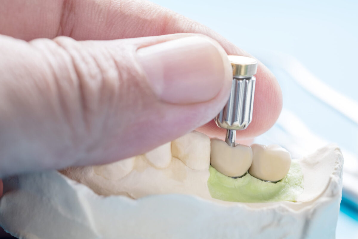 Dental Implants vs. Bridges